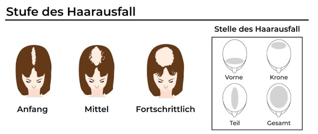 Stufe des Haarausfall frauen