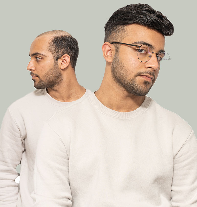 haarsystem fur manner